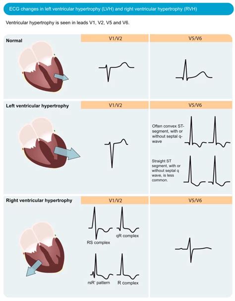 lv hypertrophy|lv hypertrophy criteria.